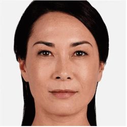 JUVÉDERM® VOLUMA® XC Before & After Patient #1655